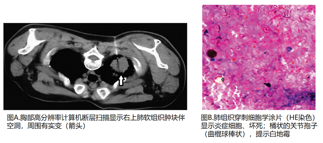 膣酵母感染症の原因は何ですか?