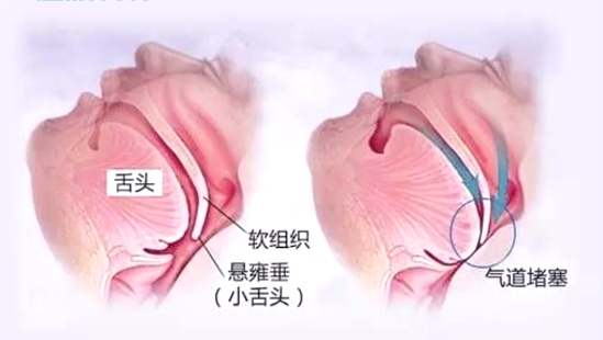 慢阻肺患者睡眠容易出现的三个问题