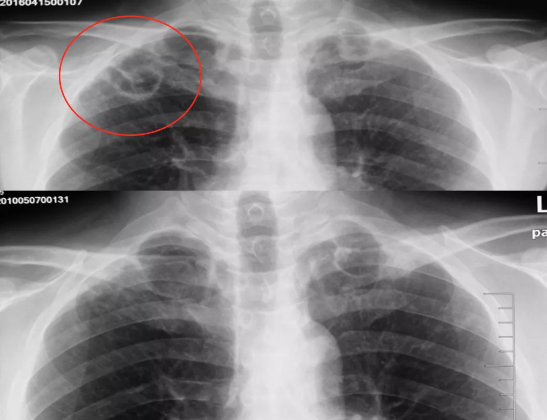 气胸、胸腔积液，胸膜疾病影像学有这些特点，一文整理！ │以影识病_气胸_胸腔积液_影像学_医脉通