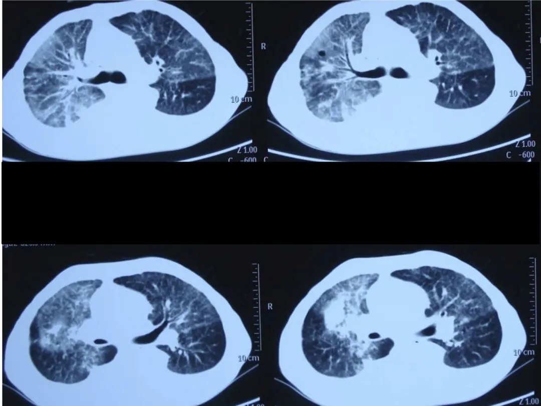 肺大泡与大泡型肺癌 - 知乎