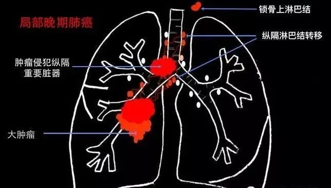 医生说肺癌晚期的「五年生存率」是最多活五年吗？不能手术的晚期肺癌还能有好几种治疗方法！ 科普头条 看呼吸 2897