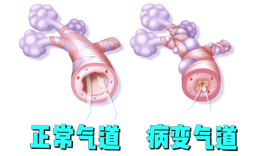 专家为什么强调慢阻肺患者需要用吸入药？