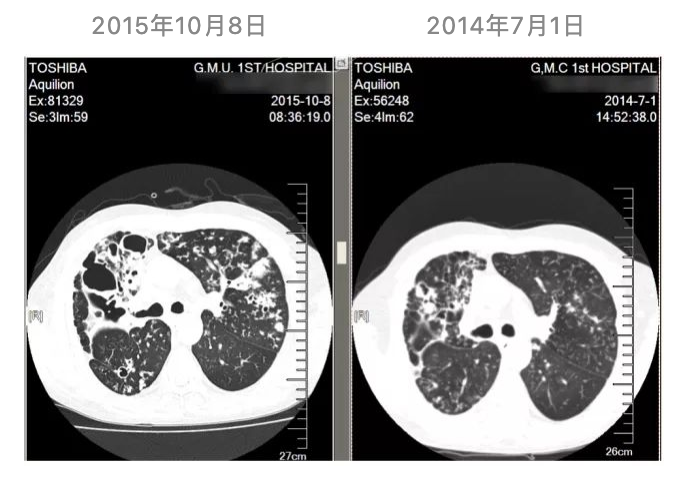 导致支气管扩张病人死亡率更高的因素有哪些？重症支扩的病因筛查和