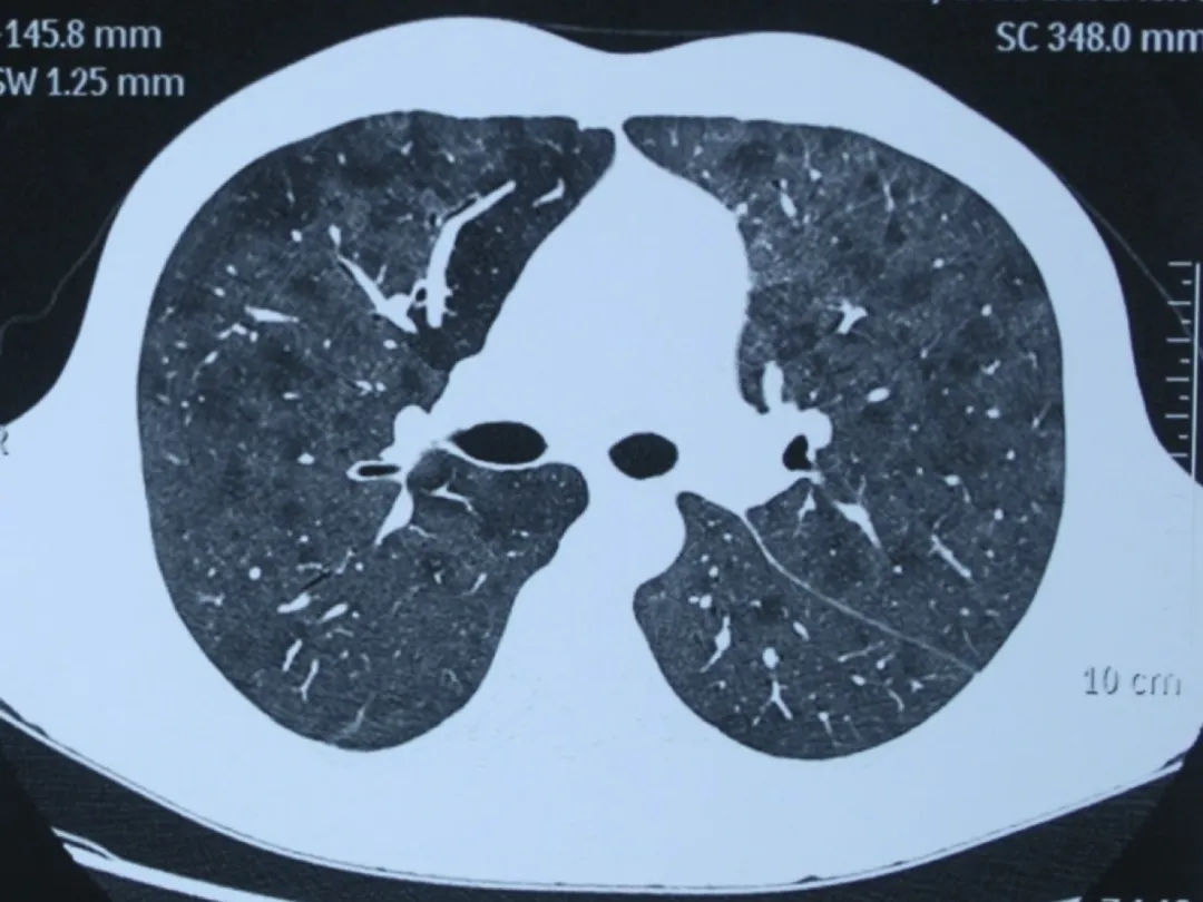 肺泡出血综合征CT影像表现_医学界-助力医生临床决策和职业成长